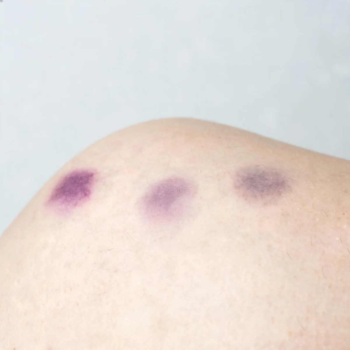 Upper back showing three separate small purple bruises in different stages of fading on pale skin, no injury marks.