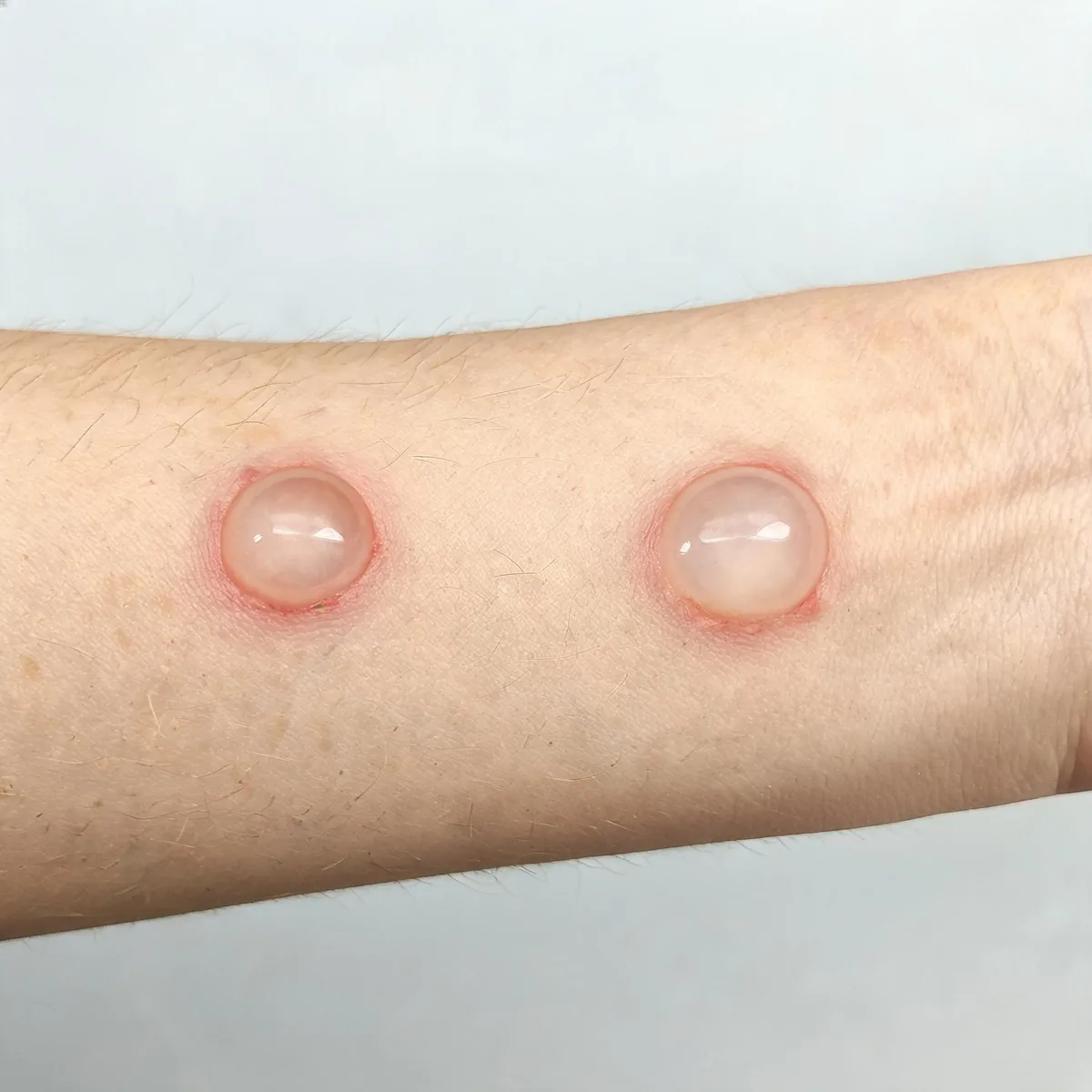 Outside of a forearm showing two tense fluid-filled bullae about one centimetre across on slightly red skin, intact roofs, no pus and no.