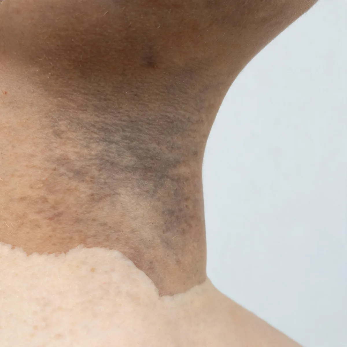 Side of the neck and jaw showing generalised dull darkening of the skin compared with a lighter patch at the collar line, no face.