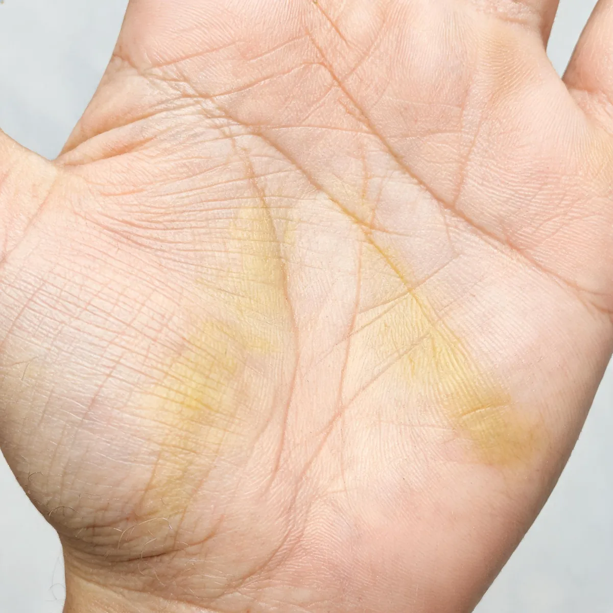 Palm of a hand showing a dull yellow-tinged discolouration of the skin creases, no sclera and no face.
