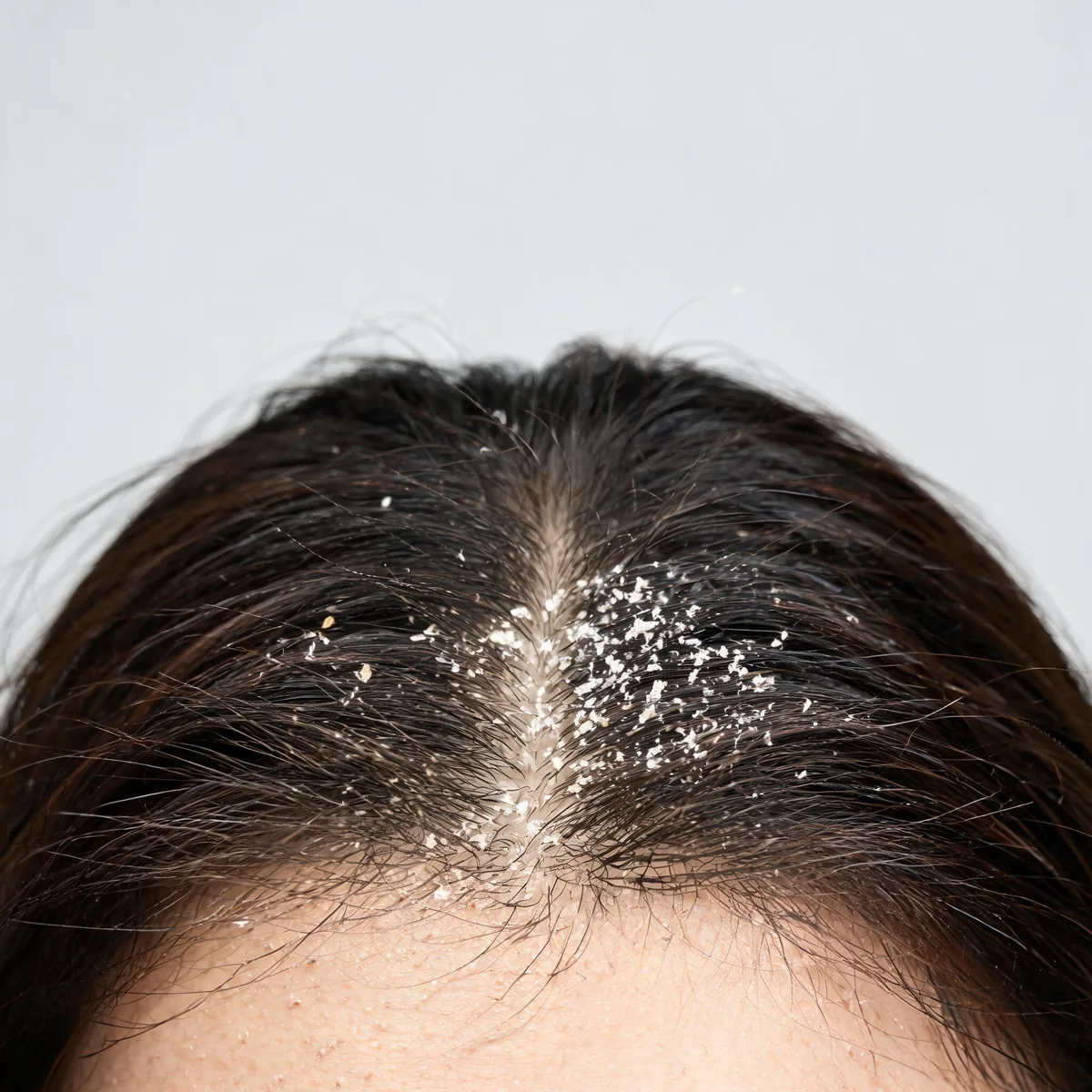 Scalp at the parting showing fine white dry flakes on a non-inflamed scalp with dry hair.