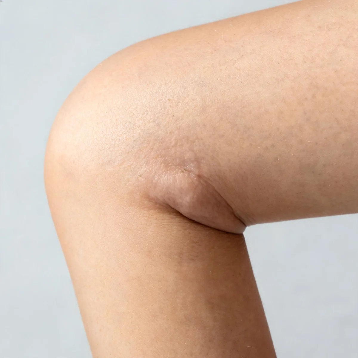 Elbow from the side showing soft tissue swelling over the olecranon with normal skin colour and no redness.