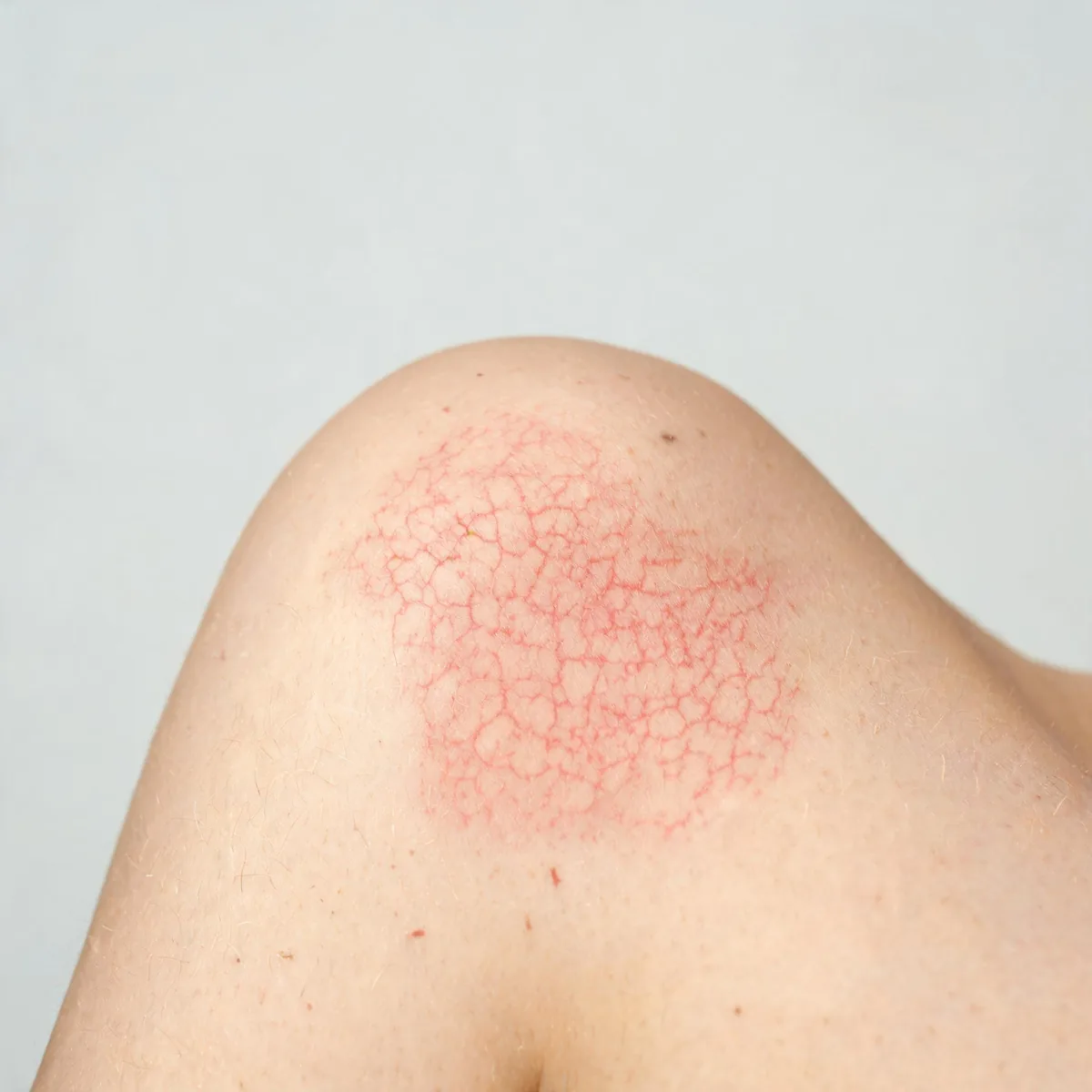 Shoulder showing a lacy reticular red rash on otherwise normal skin.