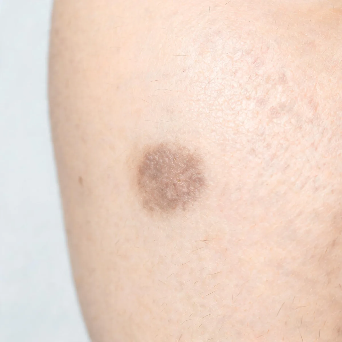 Cheek only, cropped below the eye line, showing an irregular brown-grey pigmented plaque with blurred borders, no eyes in frame.