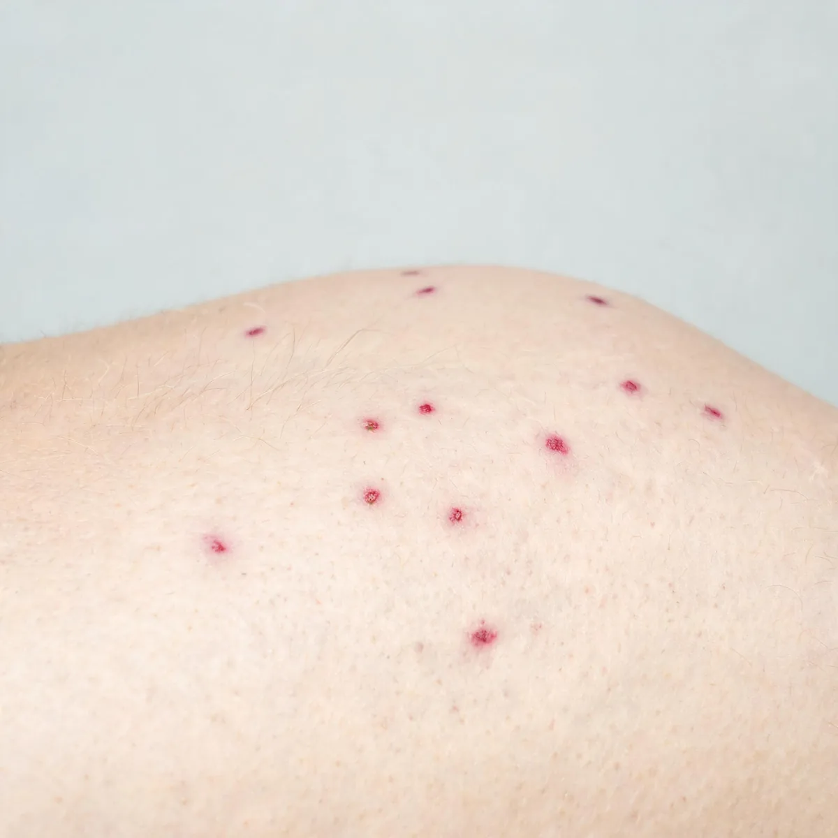 Upper back showing scattered petechiae and small purpuric spots, non-blanching, on otherwise normal skin.