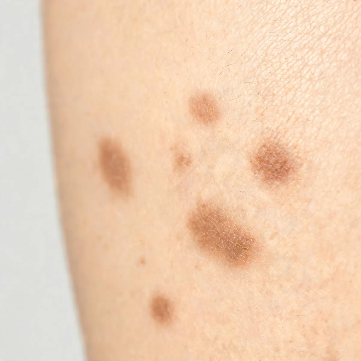 Cheek only, cropped below the eye line, showing flat brown macules with soft borders, no eyes in frame.