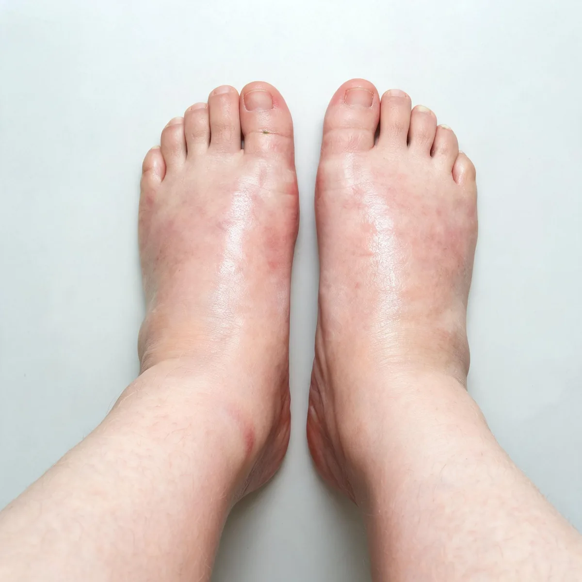 Both feet from above showing red swollen feet with shiny stretched skin and mild ankle oedema, no injury.