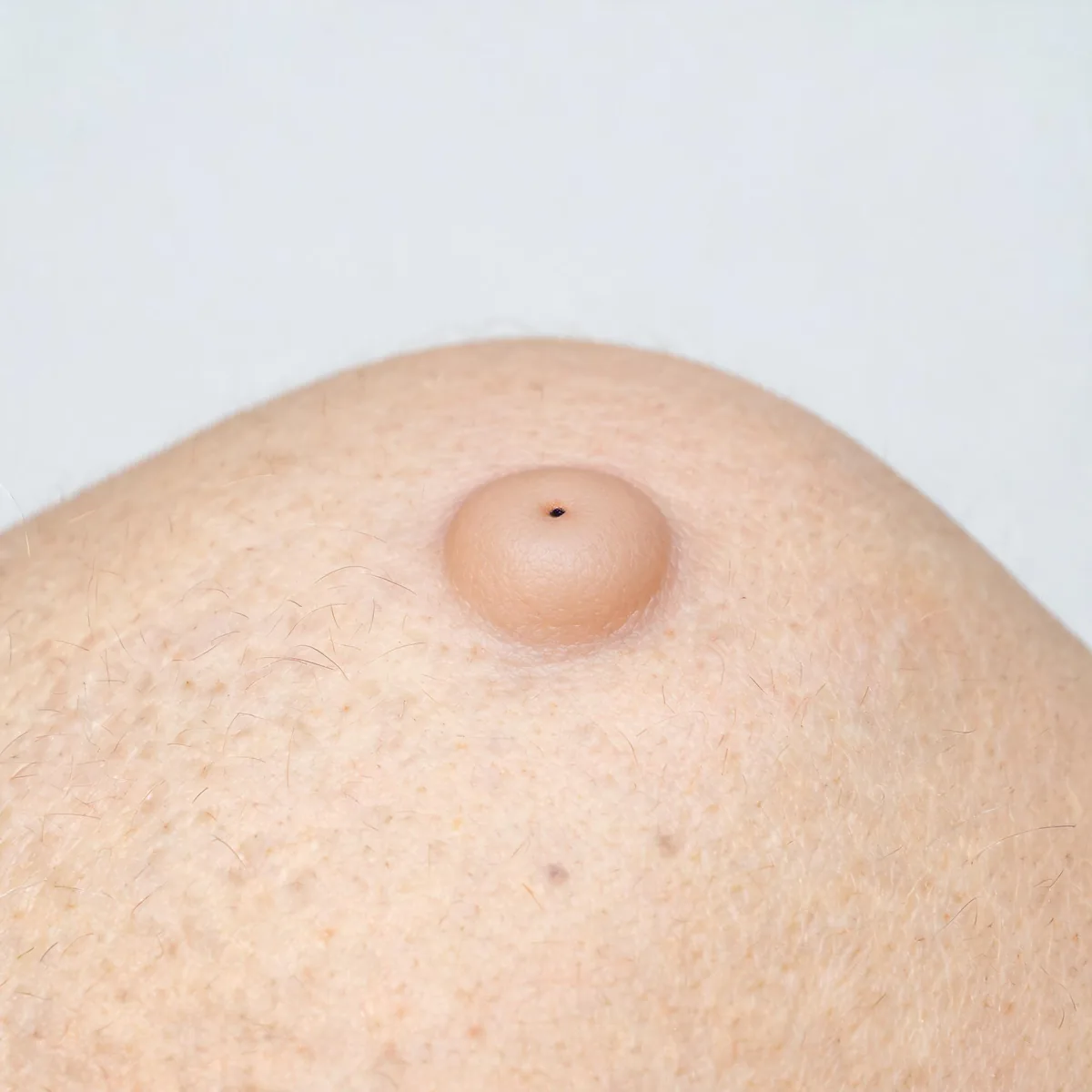 Upper back showing a smooth, dome-shaped, skin-coloured nodule with a central punctum, movable under the skin.