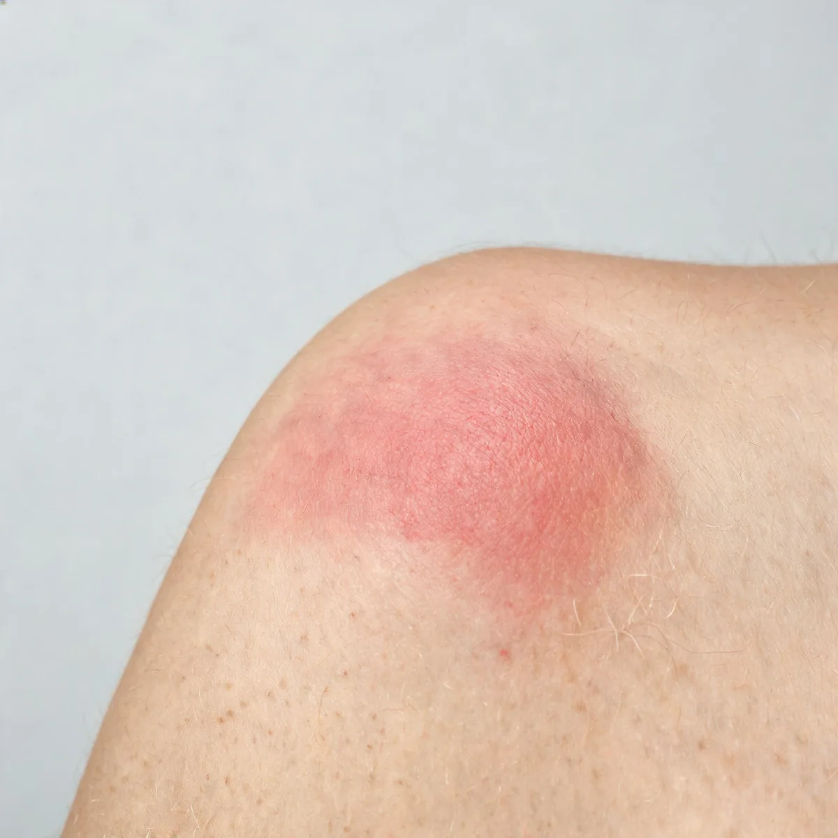 Shoulder showing a red, warm, poorly demarcated area of skin over the deltoid with mild swelling.