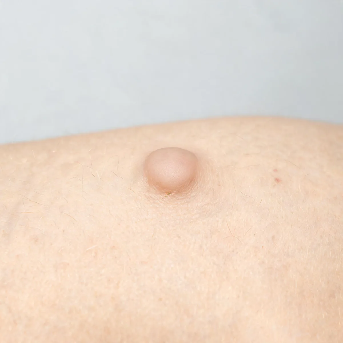 Abdomen showing a soft, skin-coloured, dome-shaped subcutaneous nodule with normal overlying skin, no redness.