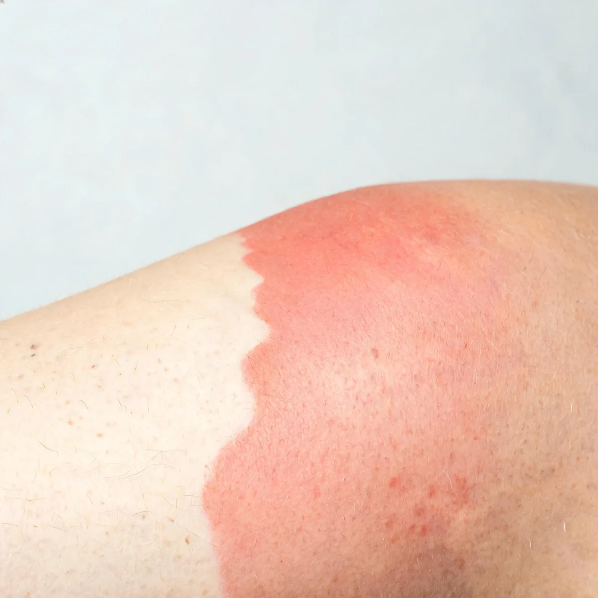Shoulder and upper arm showing sharply demarcated red sunburned skin with a clear line between burned and unburned skin, no blistering.