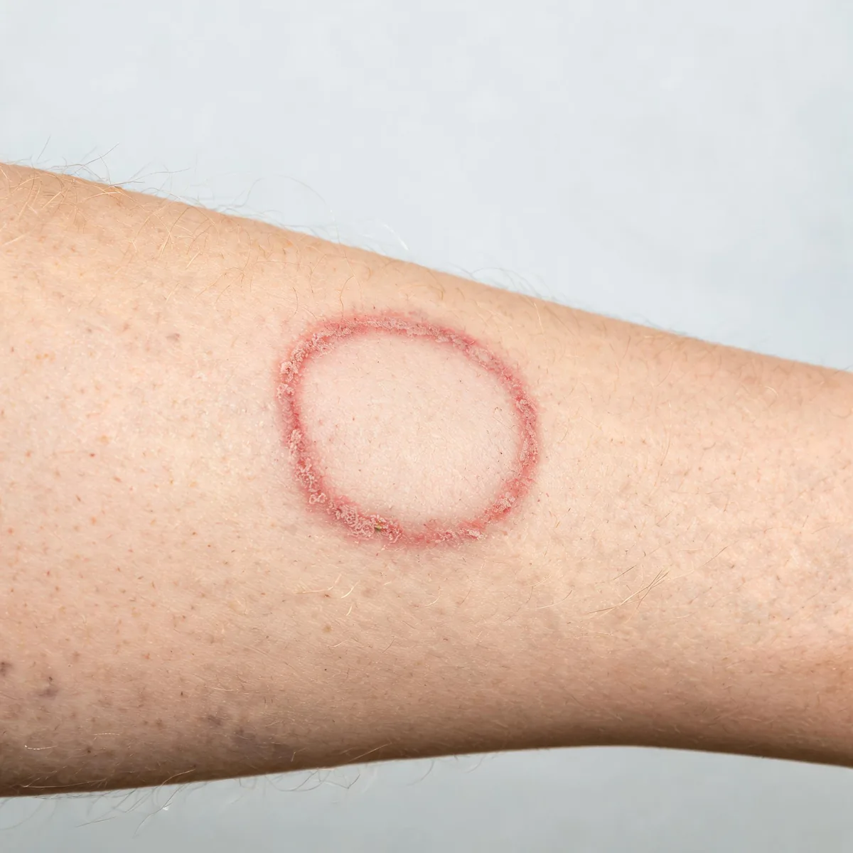 Upper arm showing an annular scaly plaque with a raised red active edge and central clearing, tinea corporis pattern.