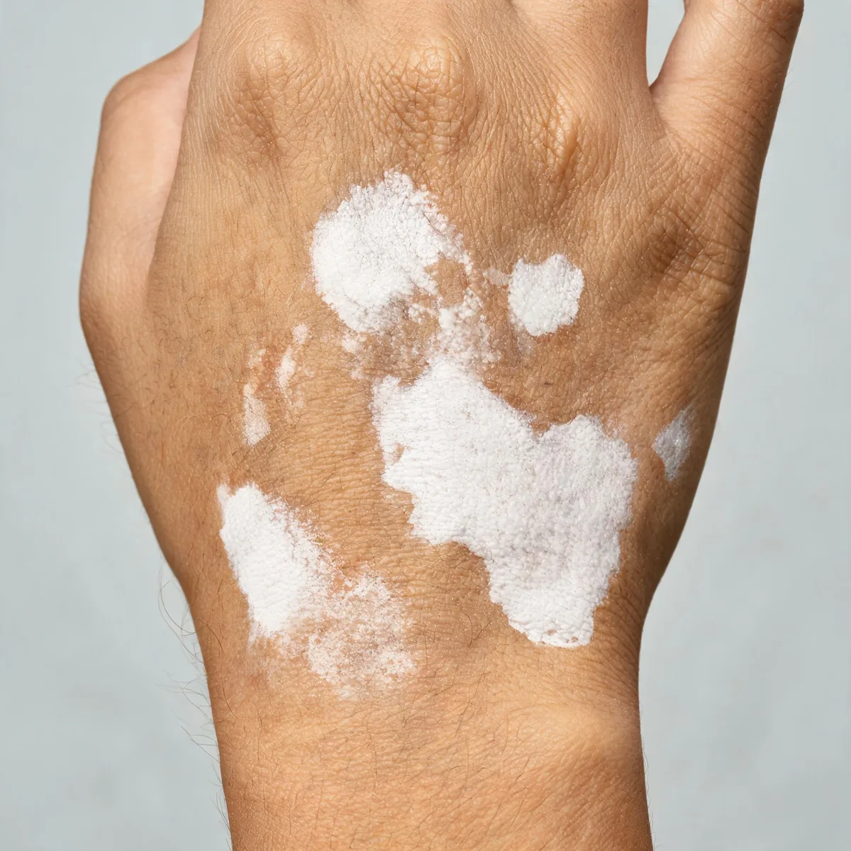 Back of a hand showing sharply demarcated depigmented white patches with normal skin around them, no redness and no scale.