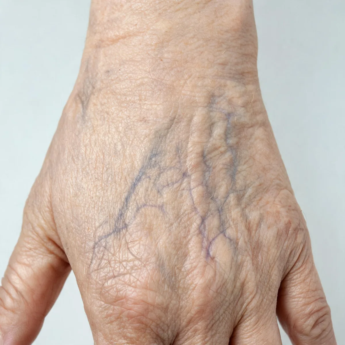 Back of the hand of an older adult showing loose, wrinkled, thin skin with prominent veins and loss of subcutaneous fat.